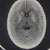 thumbnail image of Basal ganglia calcifications: on head CT, suggestive of pediatric HIV infection