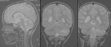 image of Progressive multifocal leukoencephalopathy 