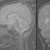 thumbnail image of Progressive multifocal leukoencephalopathy 