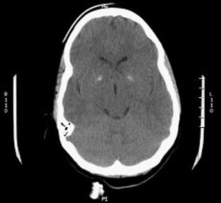 image of Cryptococcal meningitis