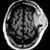 thumbnail image of Non-Hodgkin lymphoma: CT scan of head
