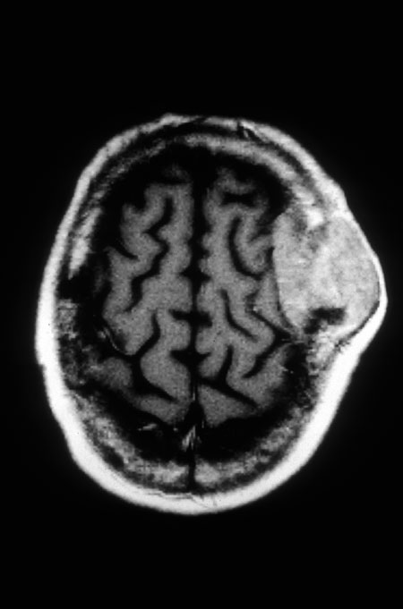 image of Non-Hodgkin lymphoma: CT scan of head