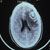thumbnail image of Toxoplasma gondii: CT scan showing cerebral abscess