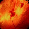 thumbnail image of Cytomegalovirus: infection of the retina