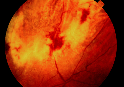 image of Cytomegalovirus: infection of the retina