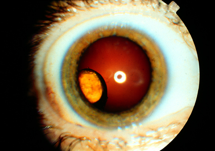 image of Ganciclovir implant