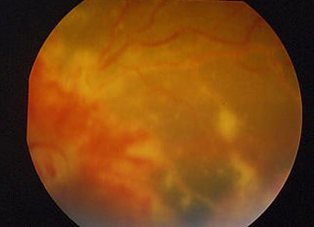 image of Cytomegalovirus retinitis: fundoscopic examination