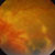 thumbnail image of Cytomegalovirus retinitis: fundoscopic examination
