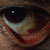 thumbnail image of Kaposi sarcoma: conjunctiva