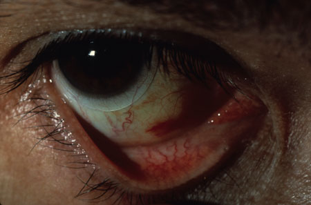 image of Kaposi sarcoma: conjunctiva