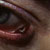 thumbnail image of Kaposi sarcoma: eyelid
