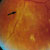 thumbnail image of Cytomegalovirus retinitis: after treatment