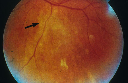 image of Cytomegalovirus retinitis: after treatment
