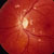 thumbnail image of Retinopathy: HIV associated