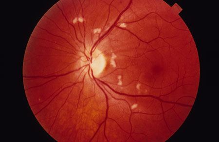 image of Retinopathy: HIV associated