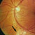 thumbnail image of Cytomegalovirus retinitis: zone of retinal necrosis