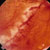 thumbnail image of Cytomegalovirus retinitis