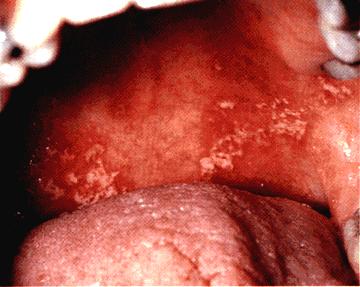 image of Candidiasis: pseudomembranous
