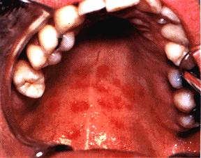 image of Candidiasis: erythematous