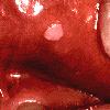 thumbnail image of Wart: on labial mucosa
