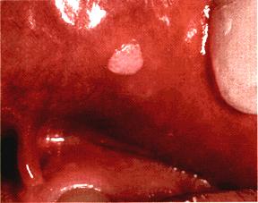 image of Wart: on labial mucosa