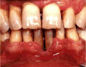 image of Necrotizing periodontal disease