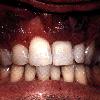 thumbnail image of Kaposi sarcoma: occurring in the gingiva