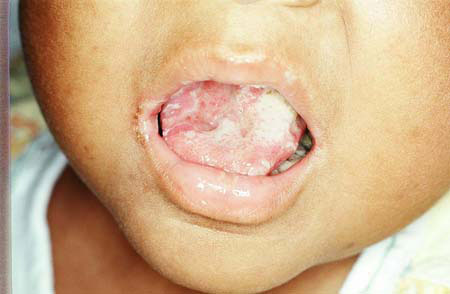 image of Candidiasis: oral