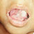 thumbnail image of Candidiasis: oral