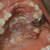 thumbnail image of Candidiasis: pseudomembranous