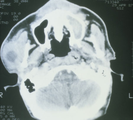 image of Non-Hodgkin lymphoma: CT scan showing parotid mass