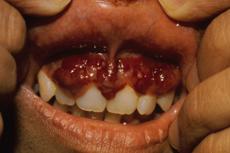 image of Kaposi sarcoma: gingival