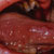 thumbnail image of Oral hairy leukoplakia