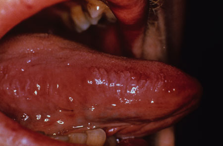 image of Oral hairy leukoplakia