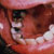 thumbnail image of Kaposi sarcoma: hyperpigmented lesions of floor of mouth