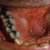 thumbnail image of Candidiasis: erythematous