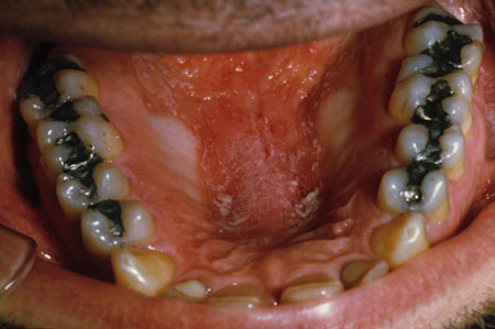 image of Candidiasis: erythematous