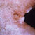 thumbnail image of Angular cheilitis