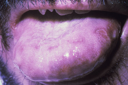 image of Herpes simplex: oral ulcers