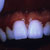 thumbnail image of Gingival erythema: linear