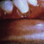 thumbnail image of Gingivitis: ulcerative