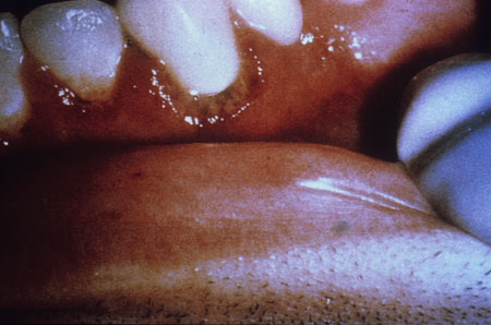 image of Gingivitis: ulcerative