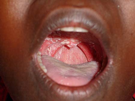 image of Candidiasis: oral (thrush) in an HIV-infected woman