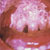 thumbnail image of Thrush: exudative