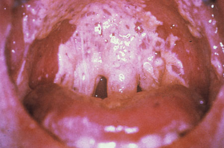 image of Thrush: exudative