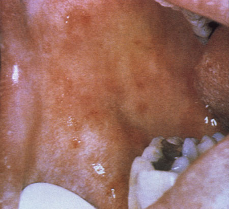 Hiv Aids Oral Manifestations Images Hiv