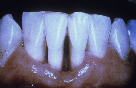 image of Periodontitis: ulcerative