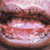thumbnail image of Stevens-Johnson syndrome