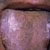 thumbnail image of Coated tongue