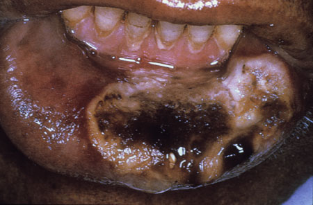 image of Actinomycosis